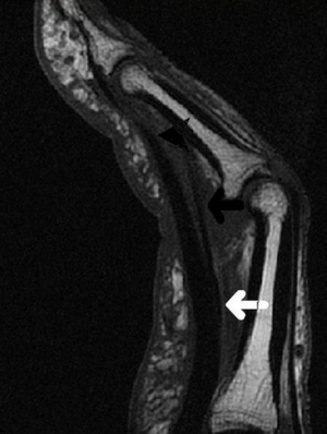A2 pulley damage - this is not my finger, but is most likely the injury that I have