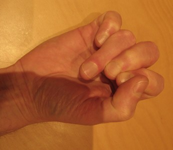 Old tendon injury to ring finger of right hand
